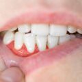 Naturally Whiten Teeth, Whiten Teeth At Home, Essential Oils Blends, Whiter Teeth, Whiten Teeth, Yellow Teeth