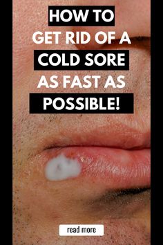 How to get rid of a cold sore fast How To Get Rid Of A Cold Sore Overnight, Remedies For Cold Sore, Best Cold Sore Remedy Overnight, Natural Remedies For Cold Sores, Cold Sores Remedies Overnight, Diy Cold Sore Remedy Fast, How To Get Rid Of A Cold Sore Fast, Coldsore Remedies Overnight, How To Get Rid Of Cold Sores