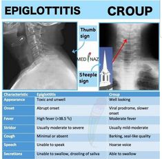 an x - ray shows the signs of eiglottitis and how to treat them