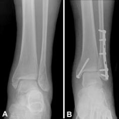 bimalleolar ankle fracture and surgical repair Broken Ankle Cast, Ankle Fracture Recovery, Fractured Ankle, Ankle Cast, Ankle Surgery Recovery, Ankle Ligaments, Ankle Fracture