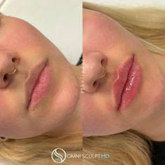 Lip Injection Before & After Gallery | OMNI SCULPT MD