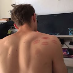 a shirtless man sitting in front of a computer monitor with red spots on his back