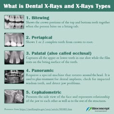 Dental Xrays Tips, Radiology Dental, Dental Assistant Radiology Study, Dental Radiology Study, Cbct Dental, Dental Radiography, Dental Radiology, Dental Nurse Revision, Dental Assistant Study Notes