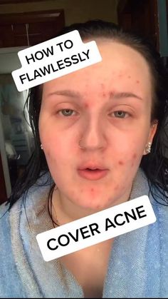 Covering Acne With Makeup, Acne Coverage, Covering Acne, Acne Makeup, Natural Everyday Makeup, Everyday Makeup Tutorials, How To Do Makeup, Natural Makeup Tutorial, Makeup Tutorial Video