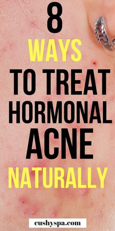 Treat Hormonal Acne, Acne Treatments, Severe Acne, Hormonal Acne, Cystic Acne