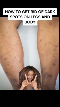 Leg Acne, Removing Hyperpigmentation, Dark Spots On Legs, Spots On Legs, Brown Spots Removal, Serious Skin Care, Dark Spots On Skin, Facial Skin Care Routine, Skin Disorders