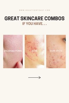 If you're dealing with enlarged pores, acne, or dark spots, don't worry—there are effective skincare combinations that can help address these concerns. Let’s explore some tailored routines designed to target and treat these common skin issues, helping you achieve a healthier, more radiant complexion. #beautyontoast #enlargedpores #acne #darkspots #skincare #skincareproducts Darkspots Skincare, Acne Dark Spots, Effective Skin Care Products, Enlarged Pores, Skin Issues, Skin Concern, Dark Spots