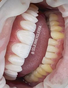 Vampire Veneers, Perfect Smile Teeth, Biker Boy, Pretty Teeth, Tooth Care, Dental Work, Veneers Teeth, Beautiful Teeth, Teeth Braces