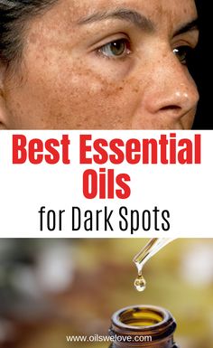 Oil For Dark Spots, Essential Oil For Dark Spots, Skin Pigmentation Remedies, Sun Spots On Face, Essential Oil For Hyperpigmentation, Treatments For Hyperpigmentation, Pigmentation On Face, Essential Oil Dark Spot Remover For Face, Sun Damage On Face