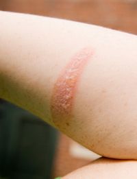 Heating Pads Can Cause Second-Degree Burns | University of Utah Health Burn Makeup, Degree Burns, Nurse Manager, Heating Pads, Stage Makeup, Heating Pad, Special Effects