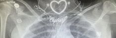 an x - ray shows the chest and lungs