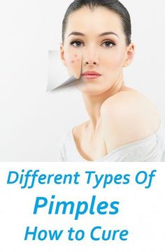 Types Of Pimples, Different Types Of Acne, Varicose Vein Removal, Baby Acne, Small Intestine, Prevent Pimples, Diy Acne