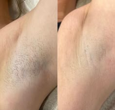 Just wanted to give a quick shout-out to one of our clients who’s seeing some amazing results from her laser hair removal treatments. After only 3 sessions, she’s noticing a huge difference – her skin is so much smoother, and she’s really excited about the progress🔥 She’s been able to cut down on her shaving routine, and she’s feeling more confident than ever. We can’t wait to see the final outcome after her next few sessions!  📲 (917) 701-0253  📞 (585)441-3838 Laser Hair Removal Room, Laser Hair Removal Results, Laser Hair Removal Cost, Hair Laser, Shaving Routine, Laser Removal, Black Friday Banner, Ipl Laser Hair Removal