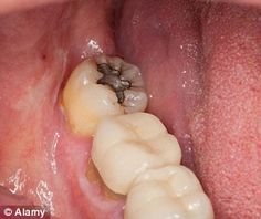 And yet dental amalgam (pictured, posed by model) is banned in countries such as Sweden and Norway, because of patient concern about the risk Chronic Bad Breath, Amalgam Fillings, Tooth Filling, Dental Fillings, Tooth Decay, Dental Care