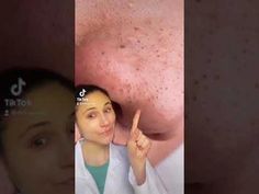 #skincare #acne #dermatologist #drdrayThis is not sponsored.  LInks contain affiliates. Panoxyl acne wash https://amzn.to/3hEhLUGPeach slices acne toner http... How To Pop Blackheads, How To Remove Blackheads From Nose, Black Head Remover Diy, How To Get Rid Of Blackheads, Pore Cleaning Videos, How To Treat Blackheads, Know Your Skin Type, Dr Dray, Removing Blackheads