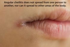 4 Home Remedies for Angular Cheilitis & 6 Self-Care Tips Angular Cheilitis Remedy Natural, Cut On Lip, Pimples On Lip Line, Cherry Angioma Removal, Lip Infection, Cracked Corners Of Mouth, Lip Pimple, Angular Cheilitis, Pinkeye Remedies