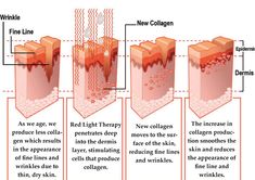 Types Of Acne, Acne Scar Removal, Pink Skin, Skin Benefits