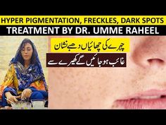 Hyper Pigmentation, Melasma, Freckles and Dark Spots Treatmment by Dr. Umme Raheel - YouTube Hyper Pigmentation, Beauty Tips, Follow Us, Anti Aging, Beauty Hacks, Health And Beauty