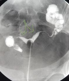 #Hysterosalpingogram shows an #anomaly of the #uterus (#bicornuate, 2 horns) in a woman with history of #miscarriages. #radiologist #radiology #hsg Radiology Registry Review, Vascular Ultrasound Registry, Chest X Ray Radiology, Upper Extremity Venous Ultrasound, Carotid Artery Ultrasound