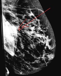 #Mammogram: collapsed saline #breast #implant. #radiologist #radiology Abstract Artwork