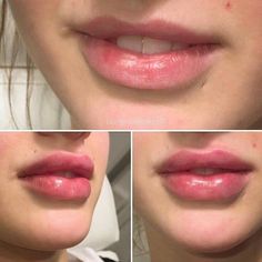 Lip Injections Juvederm, Lip Plastic Surgery, Juvederm Lips, Facial Procedure, Lips Inspiration