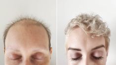 And the advice I'd give others who are struggling with cancer and hair loss. Chemo Curls, Platinum Blonde Pixie, Chemo Hair, Weak Hair, Pattern Baldness, Hair Trim, Hair Starting, Hair Regrowth, Hair Fall