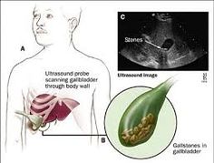 Recommended Site http://randolphlall.runnerspace.com consulting More about gallbladder pain	http://www.artoprofile.com/section/user/profile/?id=5818609 Gall Bladder, Bile Duct, Homeopathic Remedies, Homeopathy, Ultrasound, Powerpoint Presentation, Pain Relief, Natural Remedies, Account Suspended