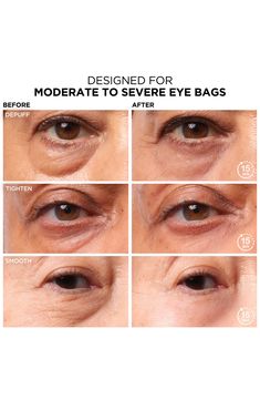 What it is: A temporary under-eye daytime treatment for moderate to severe eye bags that works to depuff, tighten and smooth in just 15 minutes.What it does: It's your temporary eye lift in a tube! Rapidly reducing the look of under-eye bags in just 15 minutes, this eye treatment dries to a smooth, transparent finish for a natural look on all skin tones. Once dry, it adapts to facial movements for comfortable, all-day wear that wont crease or crack. Formulated for daily daytime use, the temporar Eye Bag Filler, Makeup Eye Bags, Concealer For Eye Bags, Puffy Under Eyes Bags, Under Eye Bags Remedies, Under Eye Wrinkles Remedies Diy, Bags Under Eyes Remedy, Conceal Under Eye Bags, Eye Depuffing