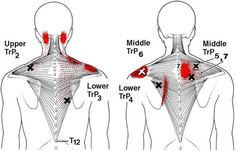 Stiff Neck, Upper Back Pain, Trigger Point, Trigger Points