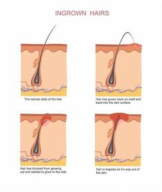 Ingrown hair can cause infections. Learn how to use the best 7 essential oils, 5 essential oil recipes and 9 home remedies to prevent and treat ingrown hair naturally! Infected Hair Follicle, Ingrown Hair Armpit, Infected Ingrown Hair, Treat Ingrown Hair, Essential Oils For Hair, Essential Oil Benefits