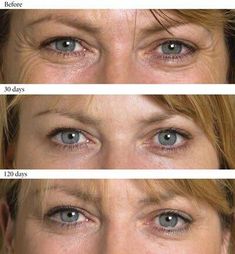 Botox Forehead, Natural Botox, Botox Before And After, Botox Alternative, Botox Injections, Marie Osmond, Dermal Fillers, Lip Fillers