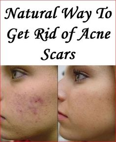 How to Get Rid of Acne Scars Fast and Naturally Chest Acne, Forehead Acne, Acne Gel, Diy Acne, Natural Acne Remedies, Natural Acne, Acne Scar Removal