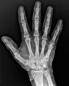 an x - ray hand is shown in black and white with the thumb exposed to show bones