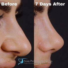 Bulbous Tip Rhinoplasty, Tip Rhinoplasty, Bulbous Nose, Small Nose