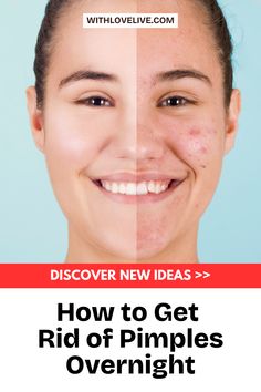 Say goodbye to pimples with our overnight solutions! 💫🌿 Learn effective methods to reduce breakouts fast and wake up to clearer skin. This complete guide is packed with tips and tricks you won’t want to miss. Save this pin now for your go-to pimple-fighting strategies! 🛌💖 Peroxide For Acne, Home Remedies For Pimples