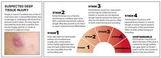 The Braden Scale for Predicting Pressure Sore Risk was developed during a Robert Wood Johnson Teaching Nursing Home project and while writing an NIH proposal to study pressure ulcer risk factors. T... Study Pressure, Medical Reference, Anatomy Organs, Nurse Teaching, Gross Anatomy