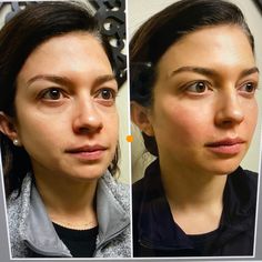 Facial Fillers Before And After, Smile Line Fillers Before And After, Cheekbone Filler Before And After, Jawline Fillers Before And After, Cheek Fillers Before And After Face, Facelift Before And After, Liquid Facelift, Juvederm Voluma, Tear Trough