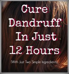 The ONLY way I've ever found to get rid of dandruff easily and naturally. And I've tried everything! Eyebrow Dandruff, Bad Dandruff, How To Remove Dandruff, Coconut Oil Hair Growth, Coconut Oil Hair Mask, Coconut Oil For Skin