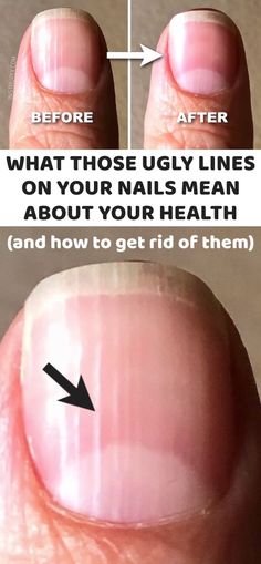 Nail Ridges, Ingrown Toenail, Fungal Nail, Health Signs, Tongue Health, Nail Art For Beginners, Lines On Nails, Nail Fungus, Nail Health