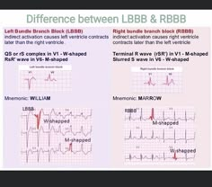 Emt Study, Bundle Branch Block, Cardiology Nursing, Ekg Interpretation, Nurse Practitioner School