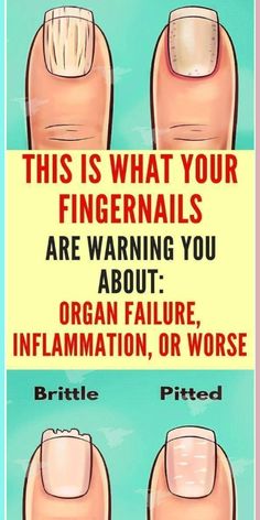 This is What Your Fingernails Are Warning You About: Organ failure, Inflammation, or worse Nail Conditions, Diy Herbal Remedies, Herbal Remedies Recipes, Diy Beauty Hacks, Natural Home Remedies, Health Conditions, Natural Medicine, Do You Know What