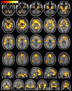 Nucleus Accumbens, Science Infographics, Brain Size, Skull Anatomy, Habit Formation, Grey Matter, Brain Structure, Magnetic Resonance Imaging