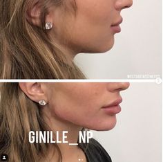 Jawline Contouring, Jawline Filler, Juvederm Voluma, Lips Shape, Face Surgery, Facial Surgery