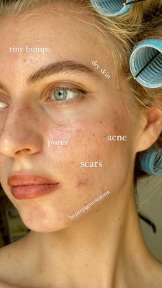 People With Acne Pretty, Imperfect Skin Aesthetic, Clean Girl With Acne, Pretty Acne Aesthetic, Natural Skin Aesthetic, Romanticizing Acne, Acne Girls Pretty, Acne Aesthetic Girl, Acne Skin Aesthetic