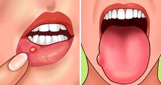 8 Simple Ways to Naturally Reverse Cavities and Heal Tooth Decay Folate Deficiency, Double Menton, Vitamin Deficiency, Canker Sore, Iron Deficiency, Lose 5 Pounds, 8th Sign, Finger Tips, Diet Keto