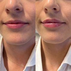 .5 mL of Lip Filler - Stunning natural results with half a syringe of lip filler - Before and after results. Full Syringe Lip Filler Before And After, .5 Syringe Lip Filler, 0.5 Lip Filler, 0.5 Lip Filler Before And After, Half Syringe Lip Filler, .5 Lip Filler, Half Syringe Lip Filler Before And After, Natural Lip Fillers 0.5ml