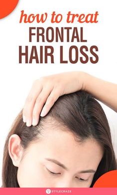 Frontal Hair, Pattern Baldness, Home Remedies For Hair, Essential Oils For Hair, Lost Hair, Hair Remedies, Hair Regrowth