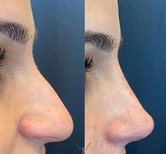 Long Nose Rhinoplasty, Nose Surgery Ideas, Nose Types Shape Names, Slim Button Nose, Straight Pointy Nose, Big Nose Rhinoplasty, Button Nose Front Profile, Piggy Nose Women, Pointy Nose Women