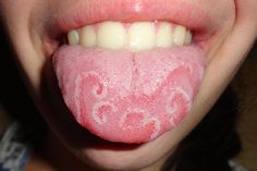 Geographic tongue is an inflammatory, but harmless, condition affecting the surface of the tongue. With geographic tongue, patches on the surface of the tongue are missing papillae and appear as smooth, red “islands,” often with slightly raised borders. Geographic tongue is said to be idiopathic in nature. With so much research connecting systemic disease with … Red Tongue, Kedokteran Gigi, Sikat Gigi, Tongue Health, Green Food Coloring, Nail Health, Oral Hygiene, Vitamin B, Oral Health