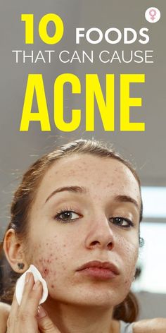 Generated Description with relevant hashtags. Foods That Trigger Acne, Acne Trigger Foods, Foods That Help Acne, Acne Causing Foods, Foods For Clear Skin, Back Acne Remedies, Cystic Acne Remedies, Different Types Of Acne, Food That Causes Inflammation